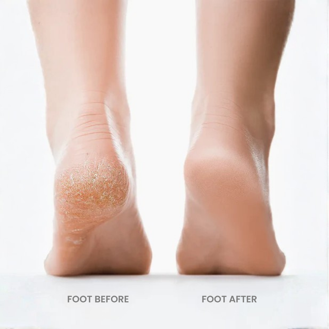 PediGlow™ Pedicure Automatic Foot Grinder